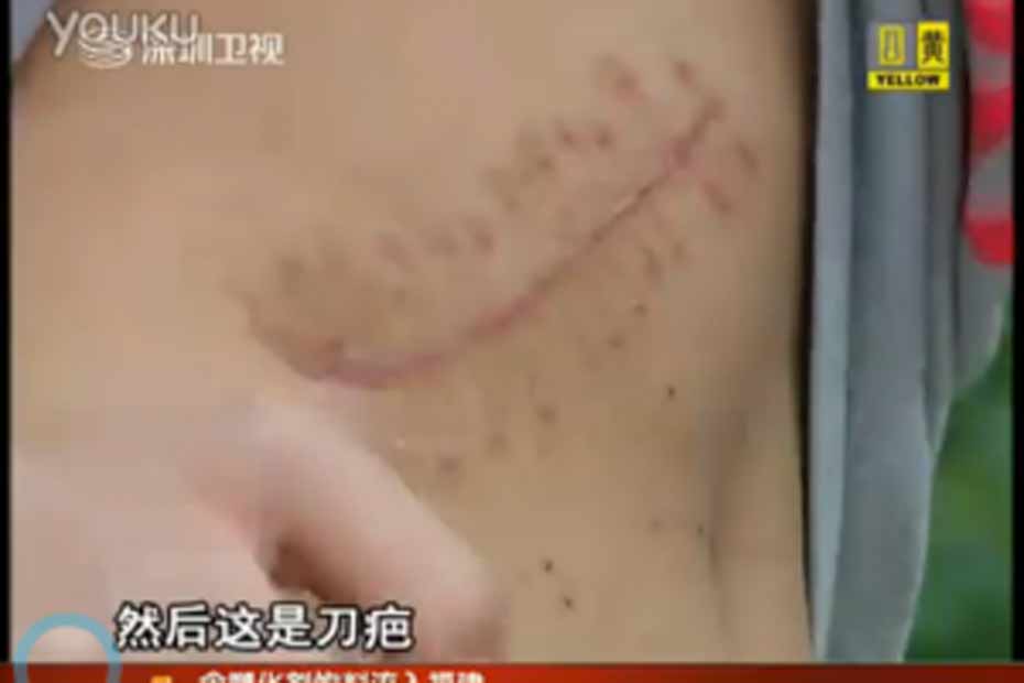 Il Vend Son Rein Pour Un Ipad