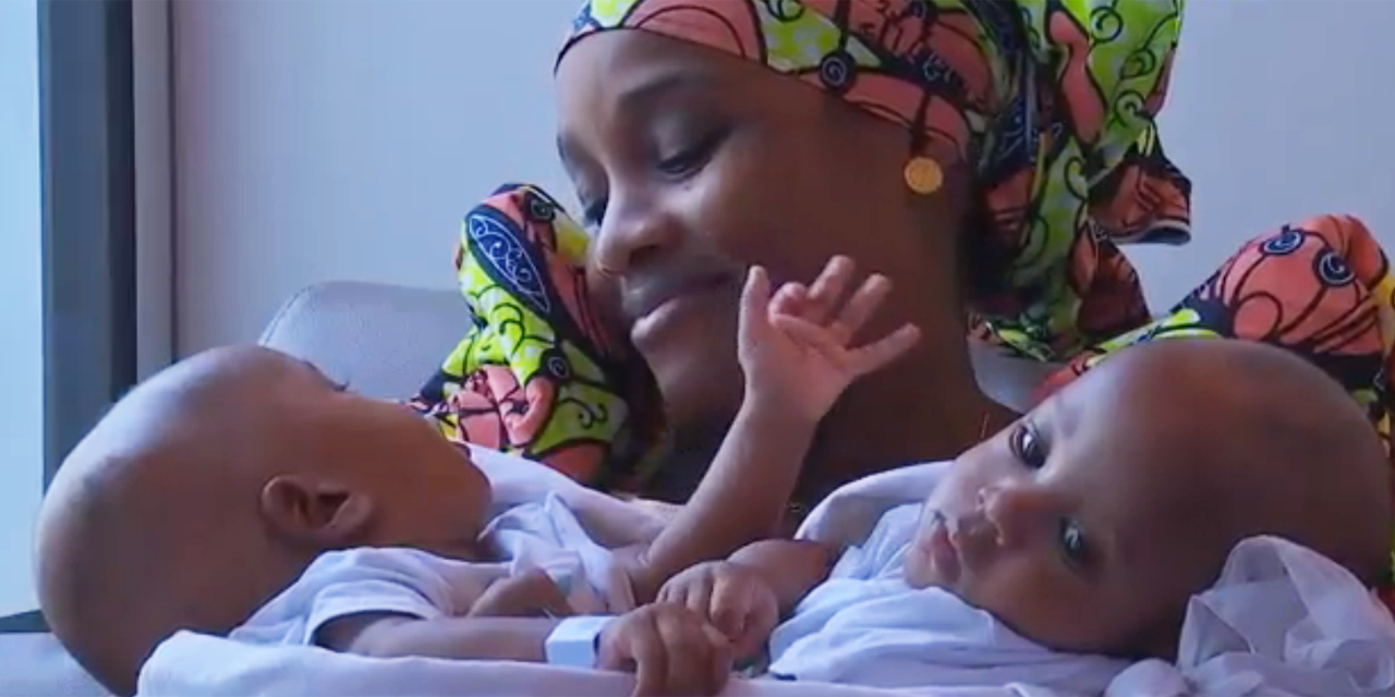 Bebes Siamois Est Il Toujours Possible De Les Separer