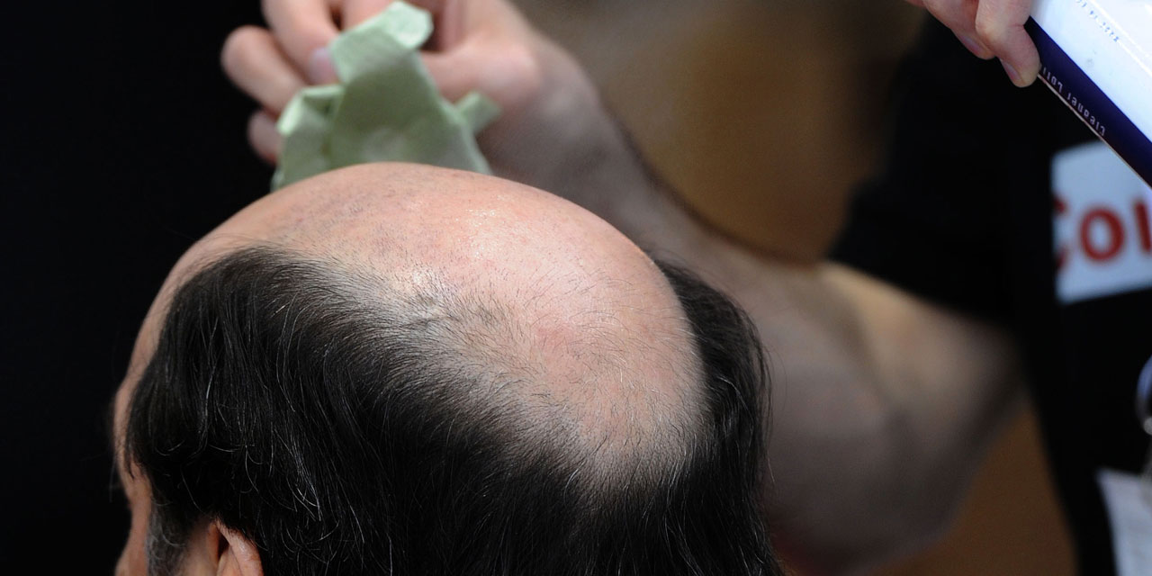 Comment traiter la chute des cheveux