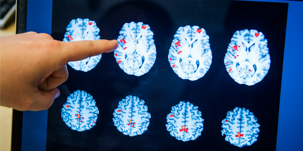 Le Trouble Du Deficit De L Attention Se Voit Dans Le Cerveau