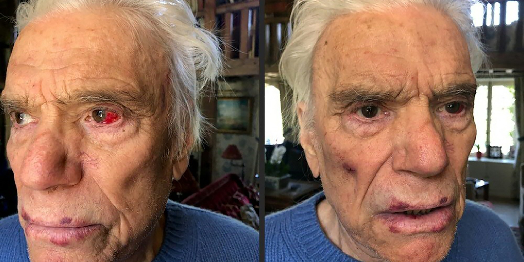 agression du couple tapie leurs blessures revelees en photo